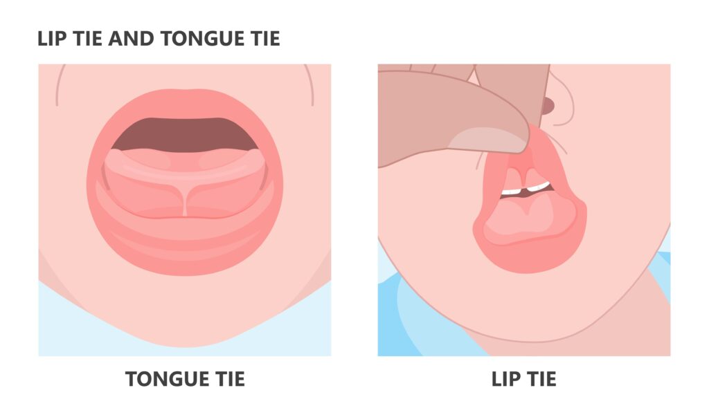tongue tie and lip tie what to look for and when to seek treatment