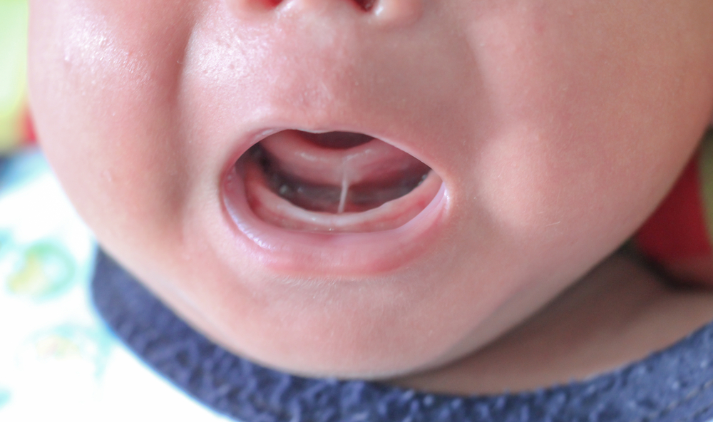 children-tongue-tie-symptoms-treatment-when-to-act